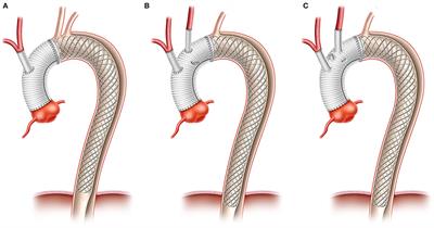 Early Results of a Novel Hybrid Prosthesis for Treatment of Acute Aortic Dissection Type A With Distal Anastomosis Line Beyond Aortic Arch Zone Zero